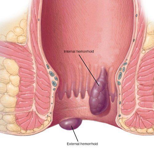 Butcher B. reccomend Hemeroids and anal leakage