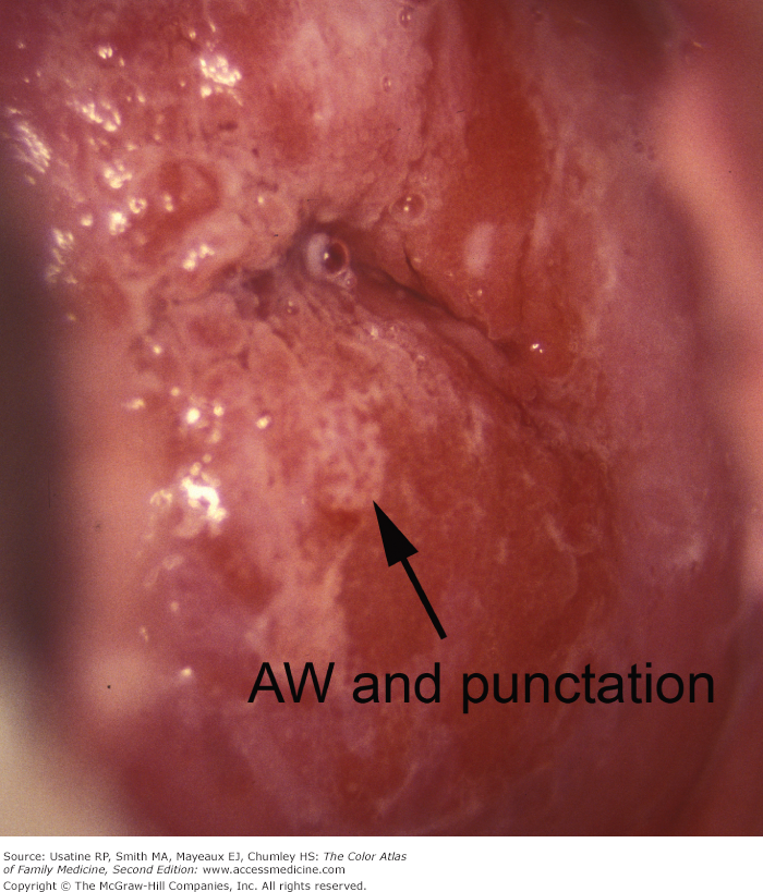 Mosiac punctations on vaginal exam for vulvar dysplasia