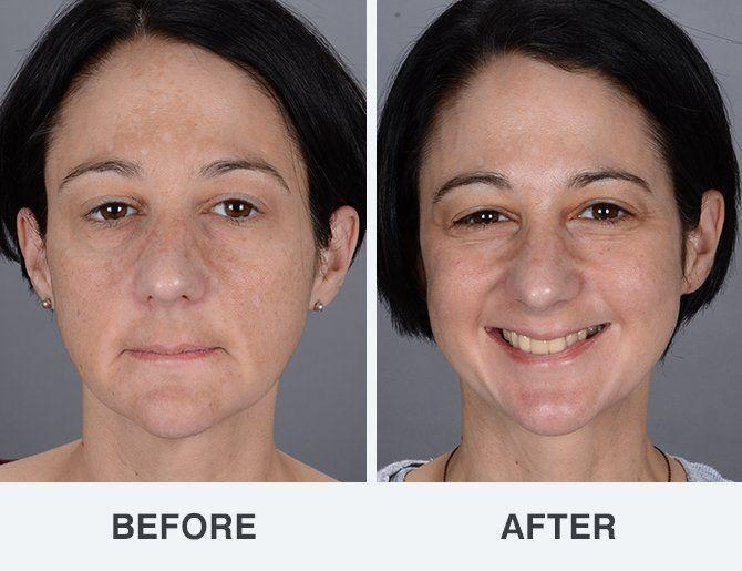 Canine reccomend Foto facial before after