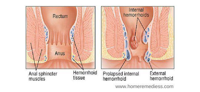 Hammerhead reccomend Anal itching and bleeding