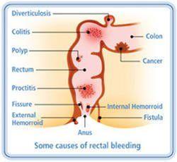 Causes of bleeding from anus