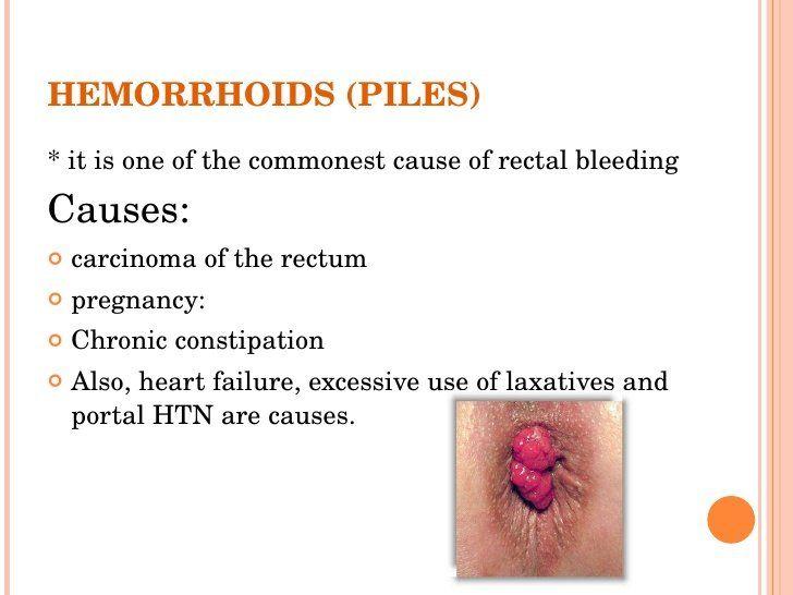 Snow W. reccomend Causes of bleeding from anus