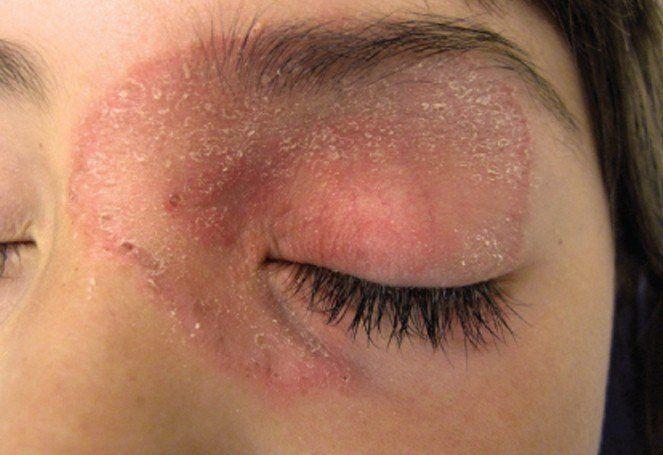 Eye Lid Facial Skin Rashes Naked Images