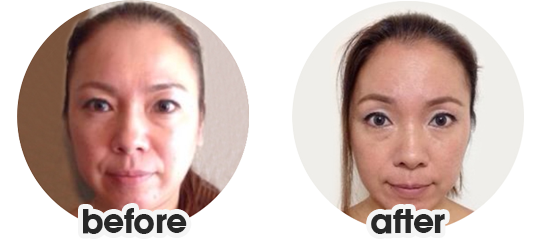 Foto facial before after