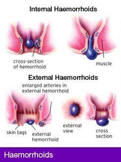 Hemeroids and anal leakage